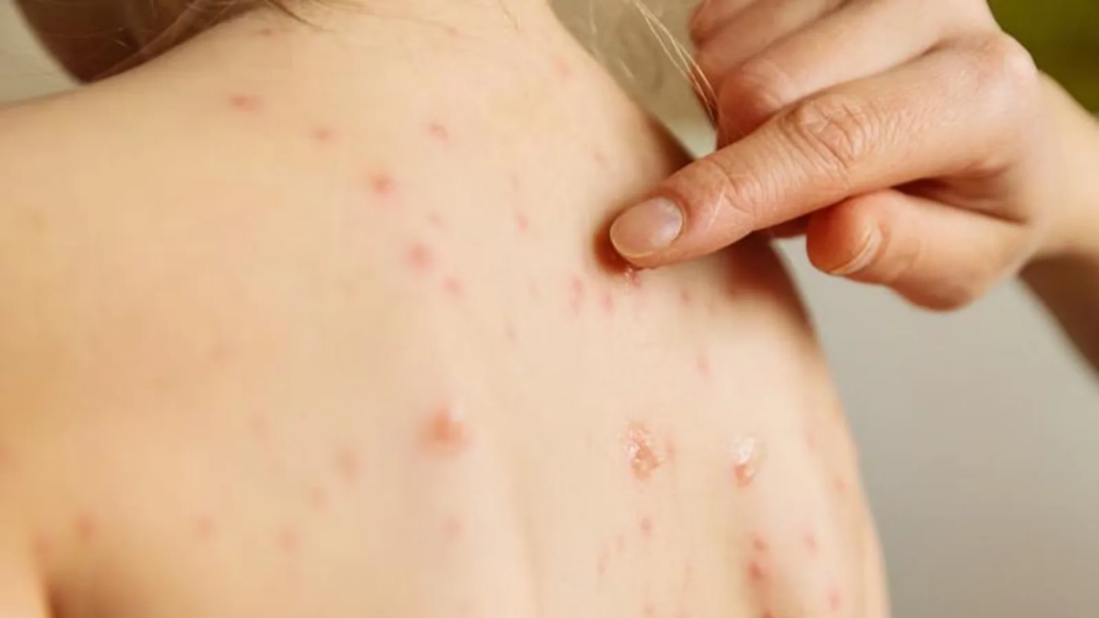 Morbillo, allarme Ministero per boom di casi, Regioni devono monitorare e vaccinare