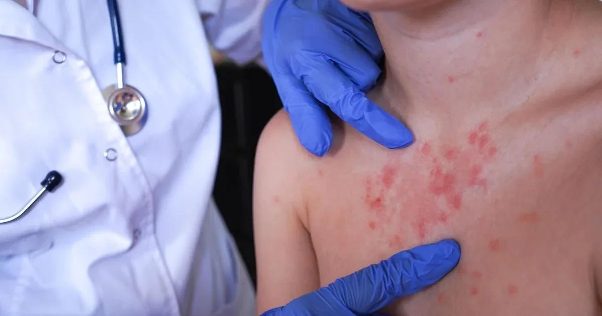 Pennsylvania's 4th measles-related death sparks vaccination concerns